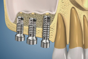 Sinus Life Internal with 3 Implants